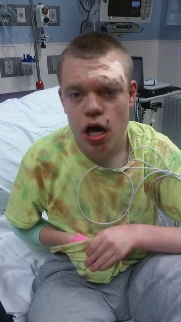 Eight stitches later...