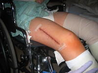 His incision.  There's a match to it on his other leg. Big!